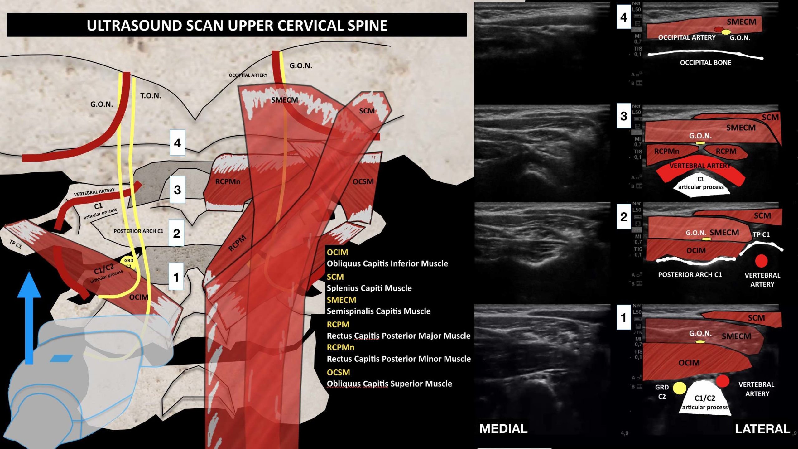 Ultrasound Scan Of The Occipital And Upper Cervical Region Annals Of