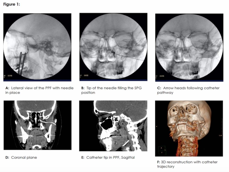 Continuous Sphenopalatine Ganglion Block for Refractory Hemicrania ...