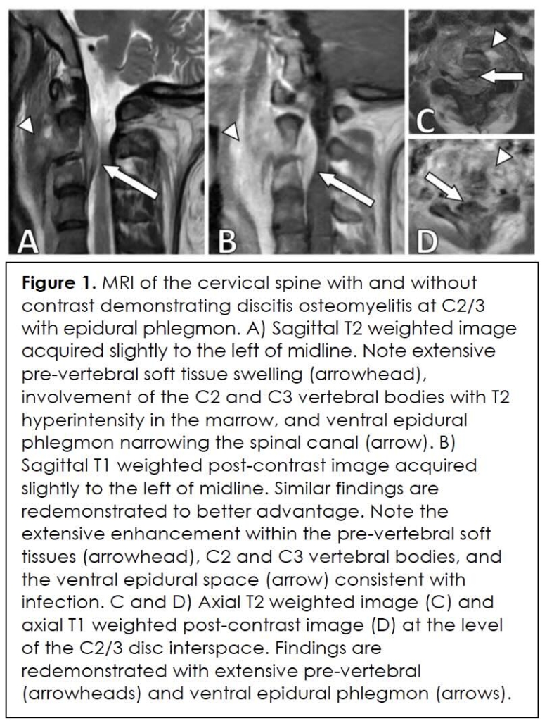 Figure 1- Sebastian-Cervical-Osteomyelitis