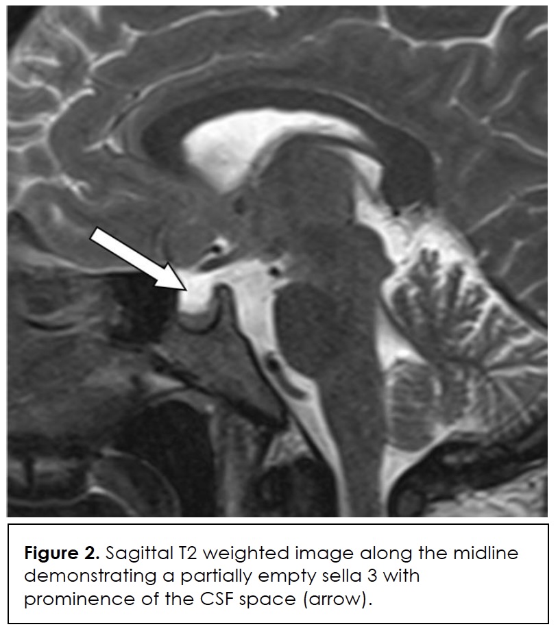 Figure 2- Sebastian-Cervical-Osteomyelitis